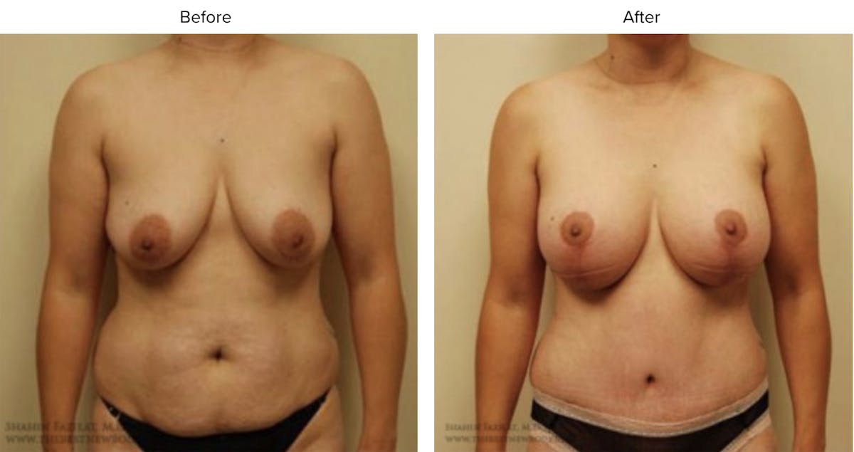 Breast Augmentation with Lift Before & After Gallery - Patient 182015 - Image 1