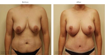 Breast Augmentation with Lift Before & After Gallery - Patient 182015 - Image 1