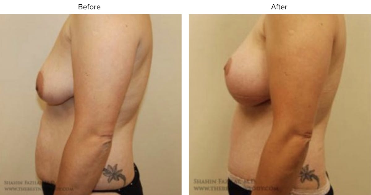 Breast Augmentation with Lift Before & After Gallery - Patient 376577 - Image 1