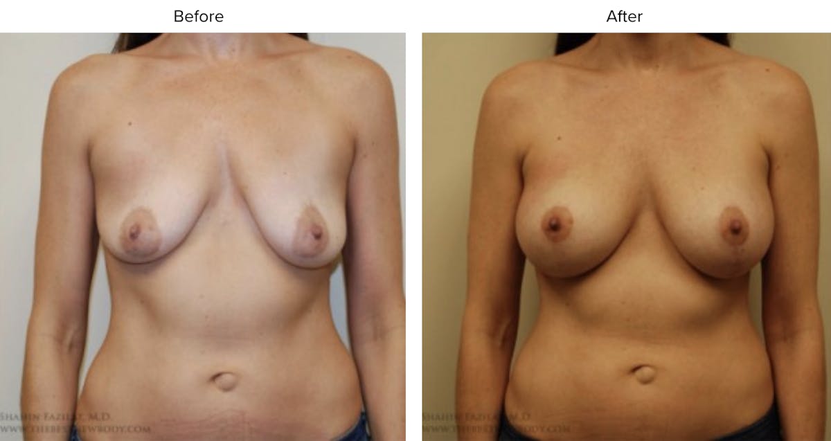 Breast Augmentation with Lift Before & After Gallery - Patient 363835 - Image 1
