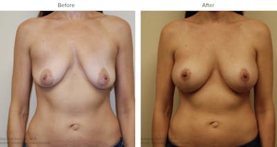 Breast Augmentation with Lift Before & After Gallery - Patient 363835 - Image 1