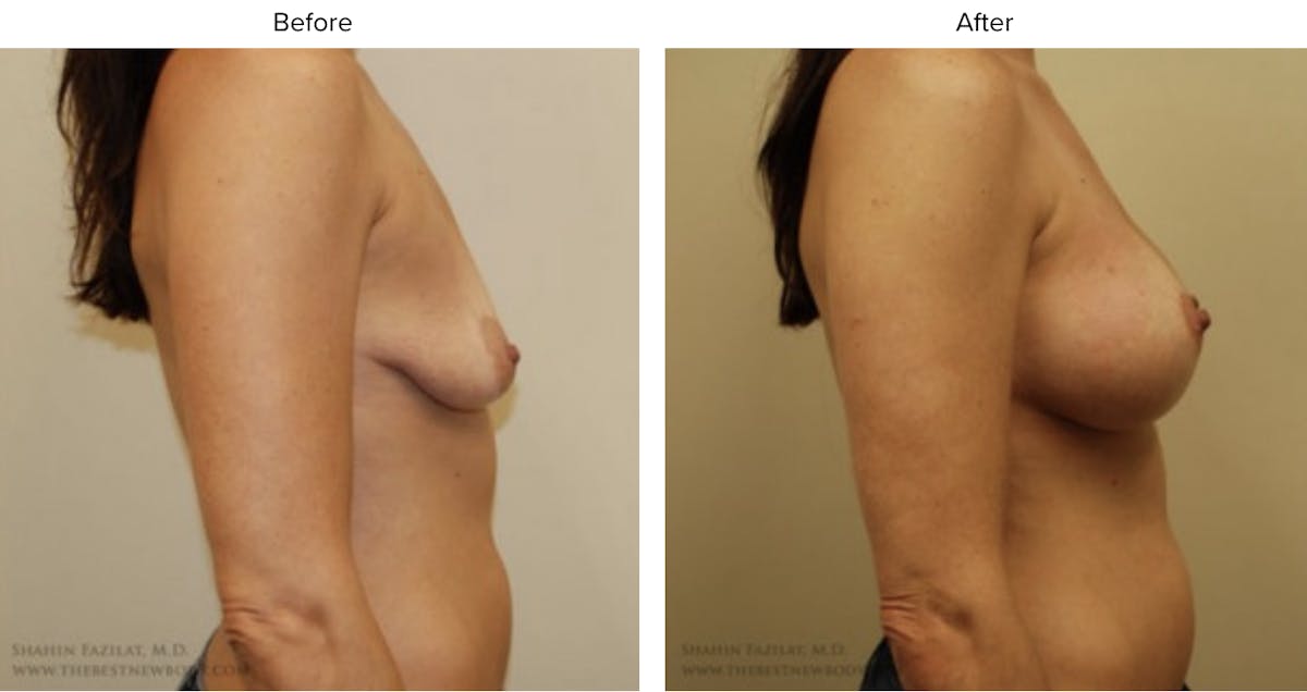 Breast Augmentation with Lift Before & After Gallery - Patient 363835 - Image 2