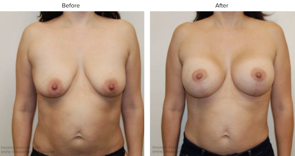 Breast Augmentation with Lift Before & After Gallery - Patient 379475 - Image 1