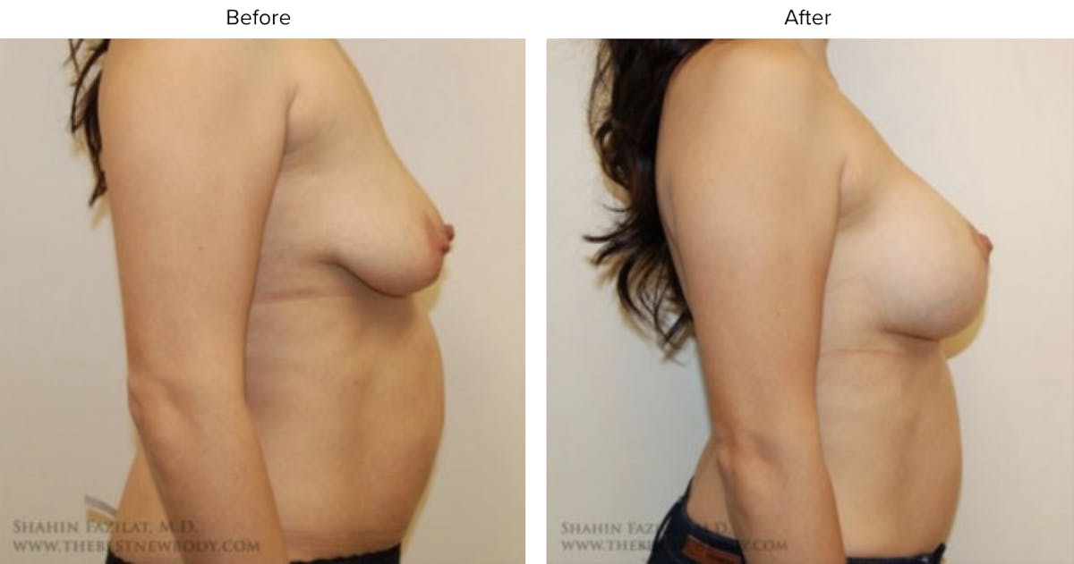 Breast Augmentation with Lift Before & After Gallery - Patient 379475 - Image 2