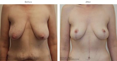 Breast Lift Before & After Gallery - Patient 130301 - Image 1