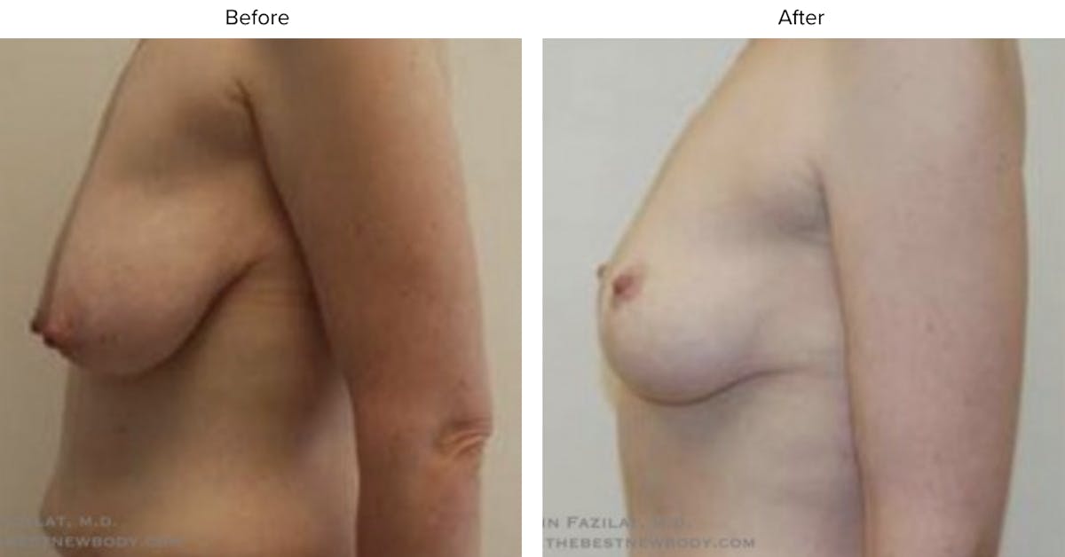 Breast Lift Before & After Gallery - Patient 130301 - Image 2
