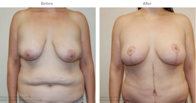 Breast Lift Before & After Gallery - Patient 233042 - Image 1