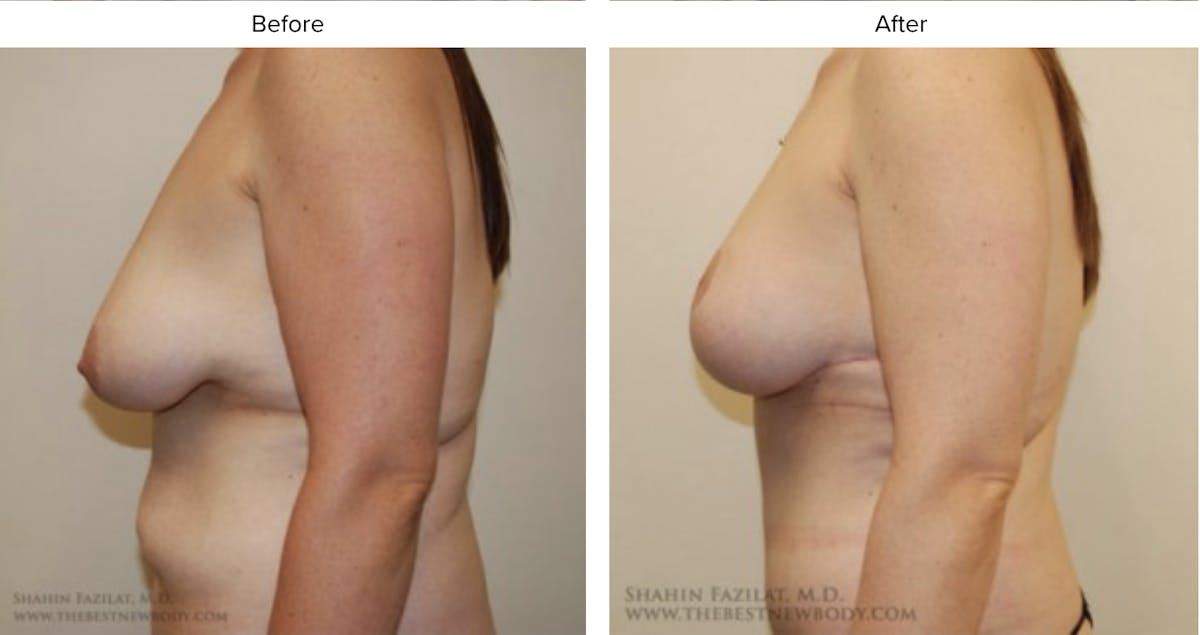 Breast Lift Before & After Gallery - Patient 233042 - Image 2