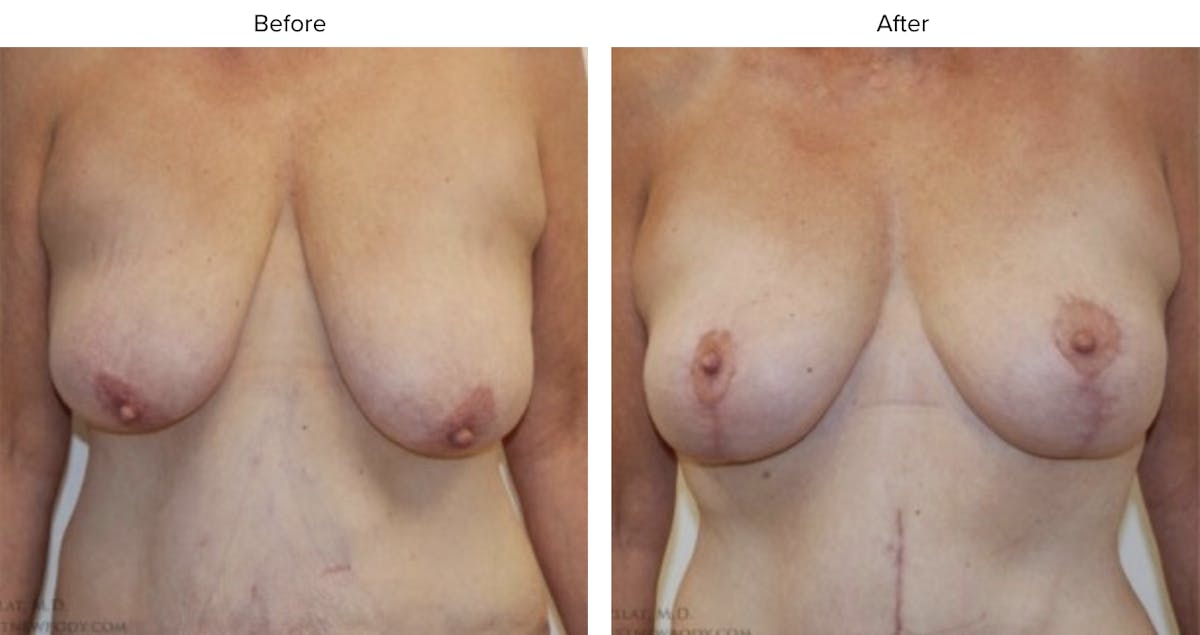 Breast Lift Before & After Gallery - Patient 150252 - Image 1