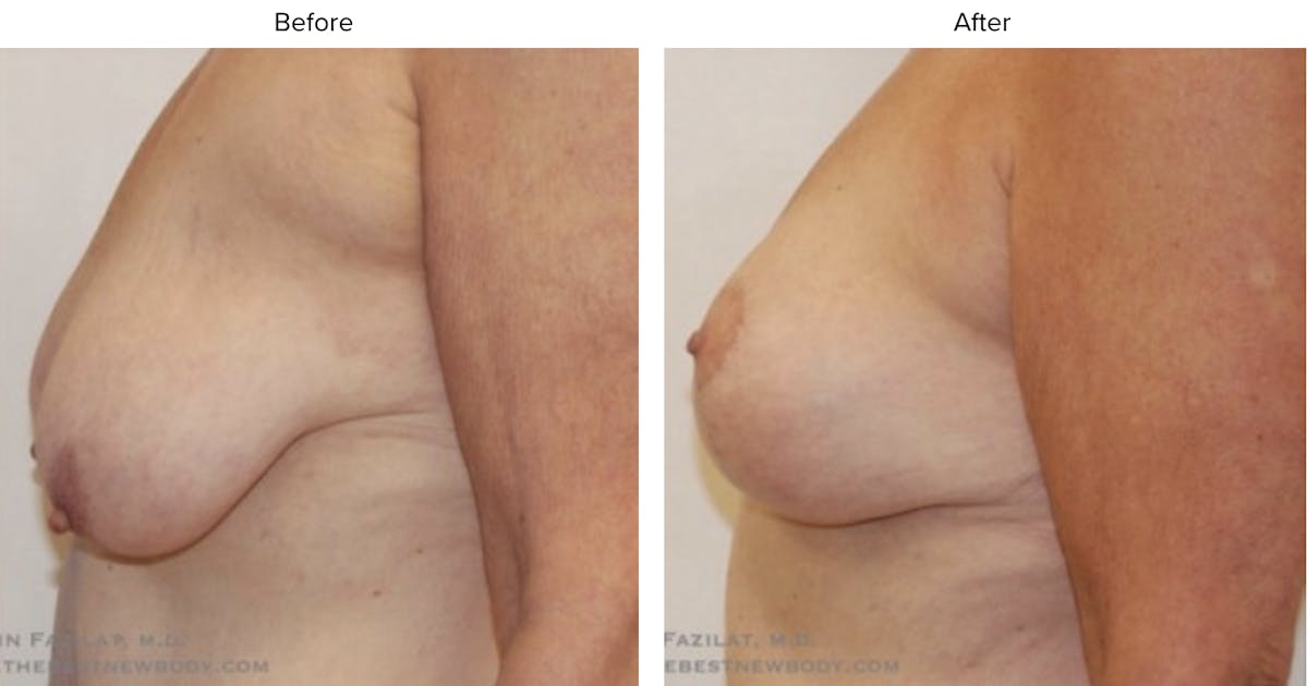 Breast Lift Before & After Gallery - Patient 150252 - Image 2