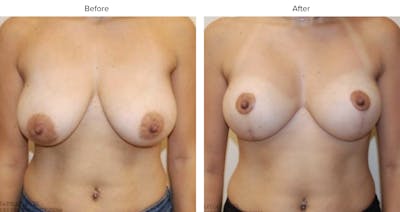 Breast Lift Before & After Gallery - Patient 107719 - Image 1
