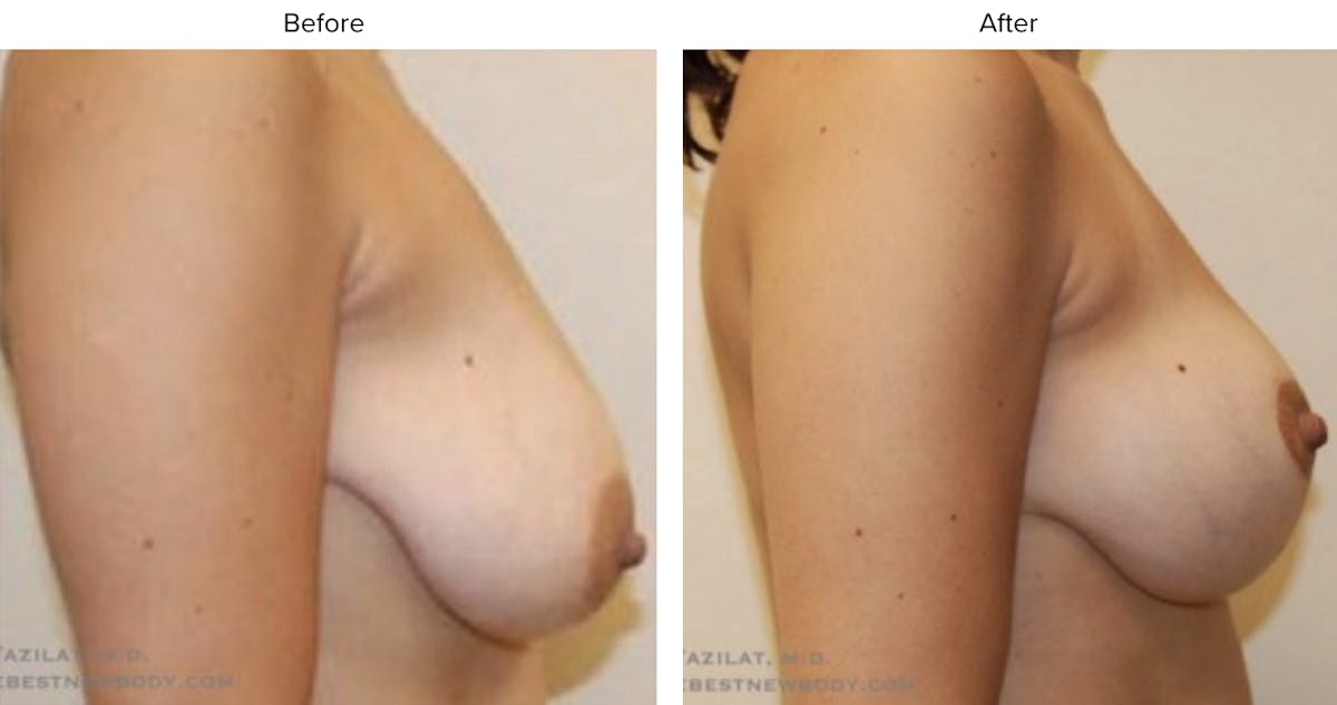 Breast Lift Before & After Gallery - Patient 107719 - Image 2