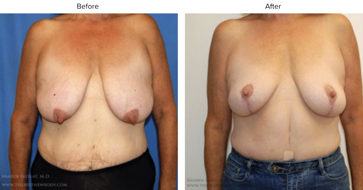 Breast Lift Before & After Gallery - Patient 370273 - Image 1
