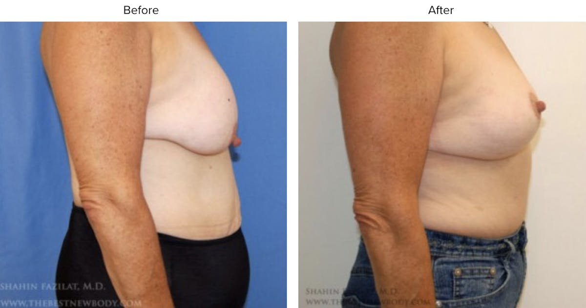 Breast Lift Before & After Gallery - Patient 370273 - Image 2