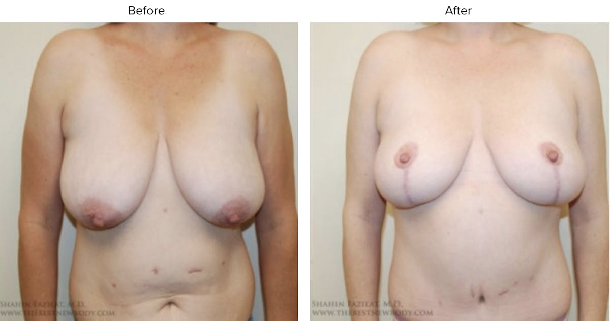 Breast Lift Before & After Gallery - Patient 345380 - Image 1