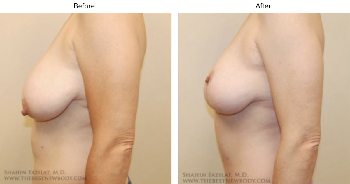 Breast Lift Before & After Gallery - Patient 345380 - Image 2