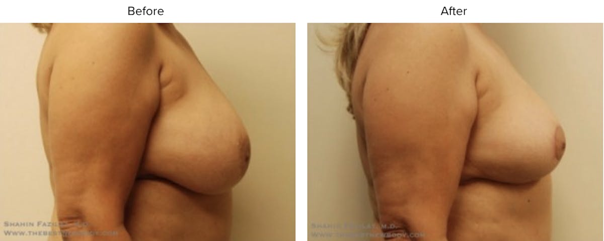 Breast Reduction Before & After Gallery - Patient 674730 - Image 2
