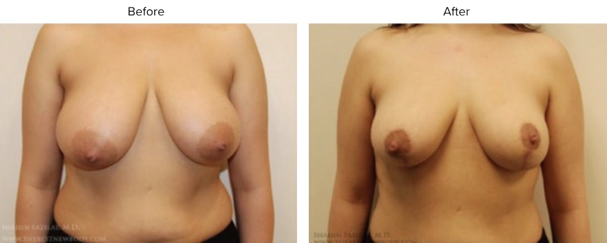 Breast Reduction Before & After Gallery - Patient 123586 - Image 1