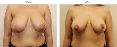 Breast Reduction Before & After Gallery - Patient 123586 - Image 1