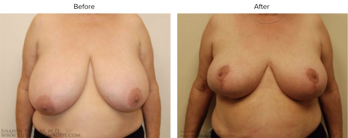 Breast Reduction Before & After Gallery - Patient 295163 - Image 1