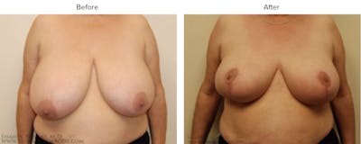 Breast Reduction Before & After Gallery - Patient 295163 - Image 1