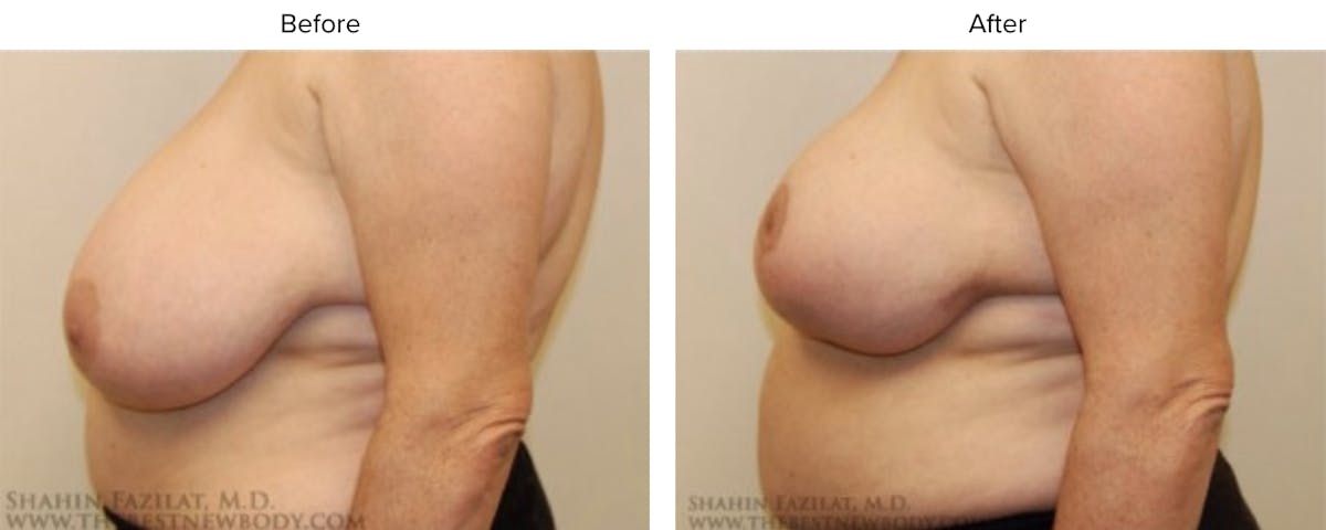 Breast Reduction Before & After Gallery - Patient 295163 - Image 2