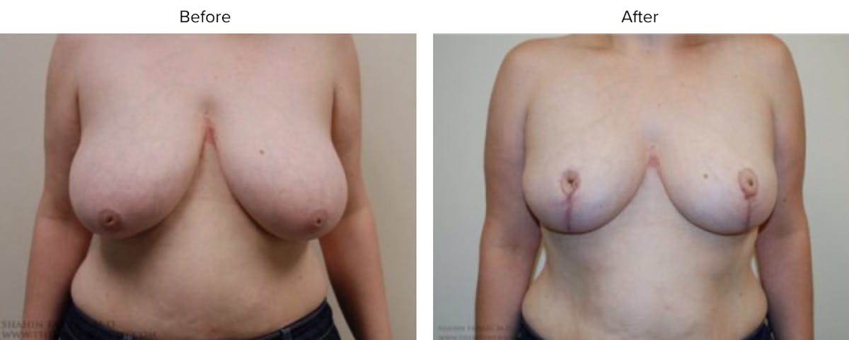 Breast Reduction Before & After Gallery - Patient 208192 - Image 1