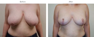 Breast Reduction Before & After Gallery - Patient 208192 - Image 1