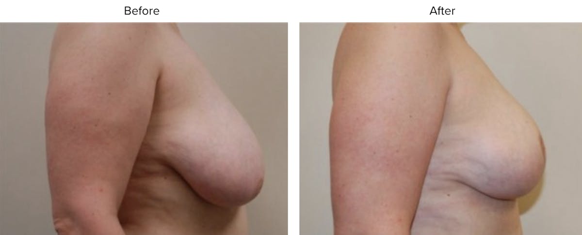 Breast Reduction Before & After Gallery - Patient 208192 - Image 2