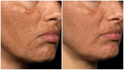 Fraxel Laser Before & After Gallery - Patient 108221 - Image 1