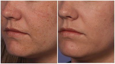 Fraxel Laser Before & After Gallery - Patient 199370 - Image 1