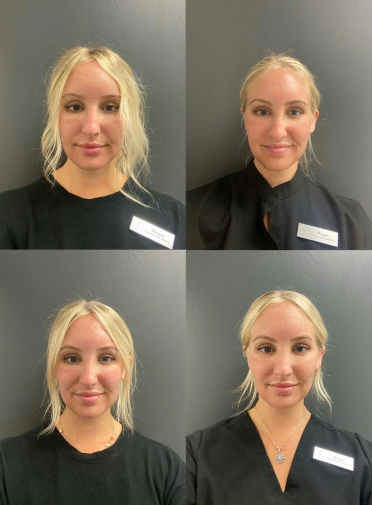 Fraxel Laser Before & After Gallery - Patient 287851 - Image 1
