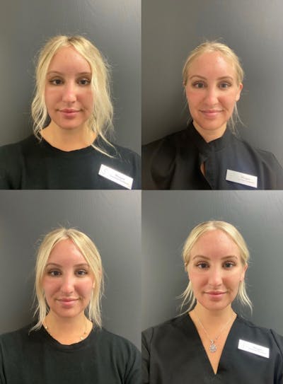 Fraxel Laser Before & After Gallery - Patient 287851 - Image 1