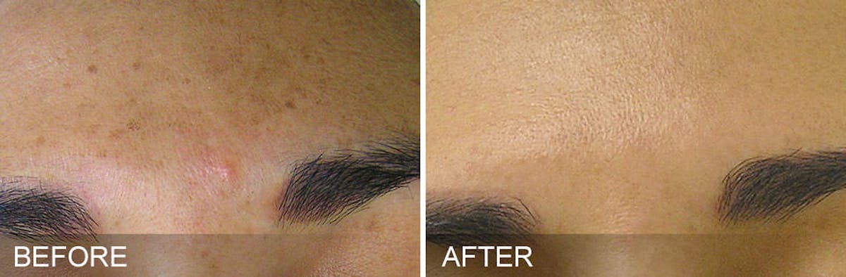 HydraFacial Before & After Gallery - Patient 316868 - Image 1