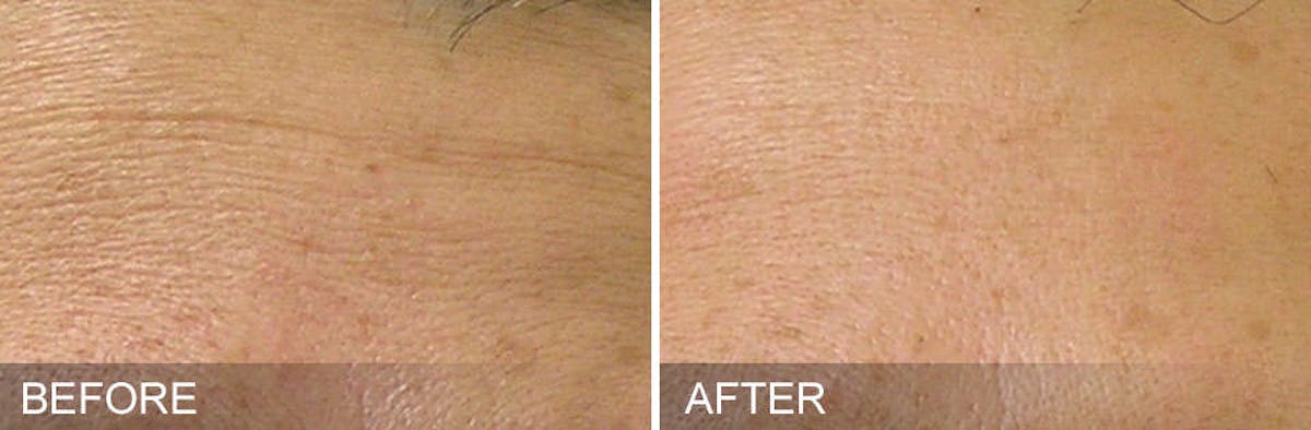 HydraFacial Before & After Gallery - Patient 164648 - Image 1