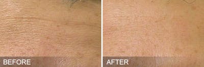 HydraFacial Before & After Gallery - Patient 164648 - Image 1