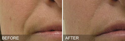 HydraFacial Before & After Gallery - Patient 167656 - Image 1