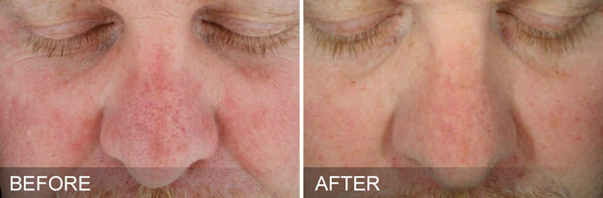 HydraFacial Before & After Gallery - Patient 189607 - Image 1