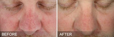 HydraFacial Before & After Gallery - Patient 189607 - Image 1
