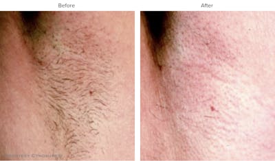 Laser Hair/Vein Removal Before & After Gallery - Patient 266404 - Image 1