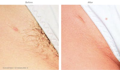 Laser Hair/Vein Removal Before & After Gallery - Patient 243803 - Image 1