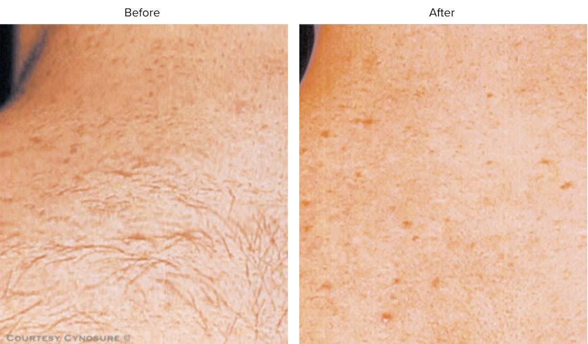 Laser Hair/Vein Removal Before & After Gallery - Patient 200351 - Image 1