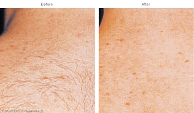 Laser Hair/Vein Removal Before & After Gallery - Patient 200351 - Image 1