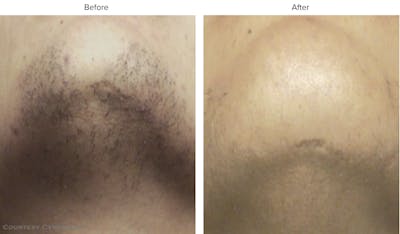 Laser Hair/Vein Removal Before & After Gallery - Patient 332239 - Image 1