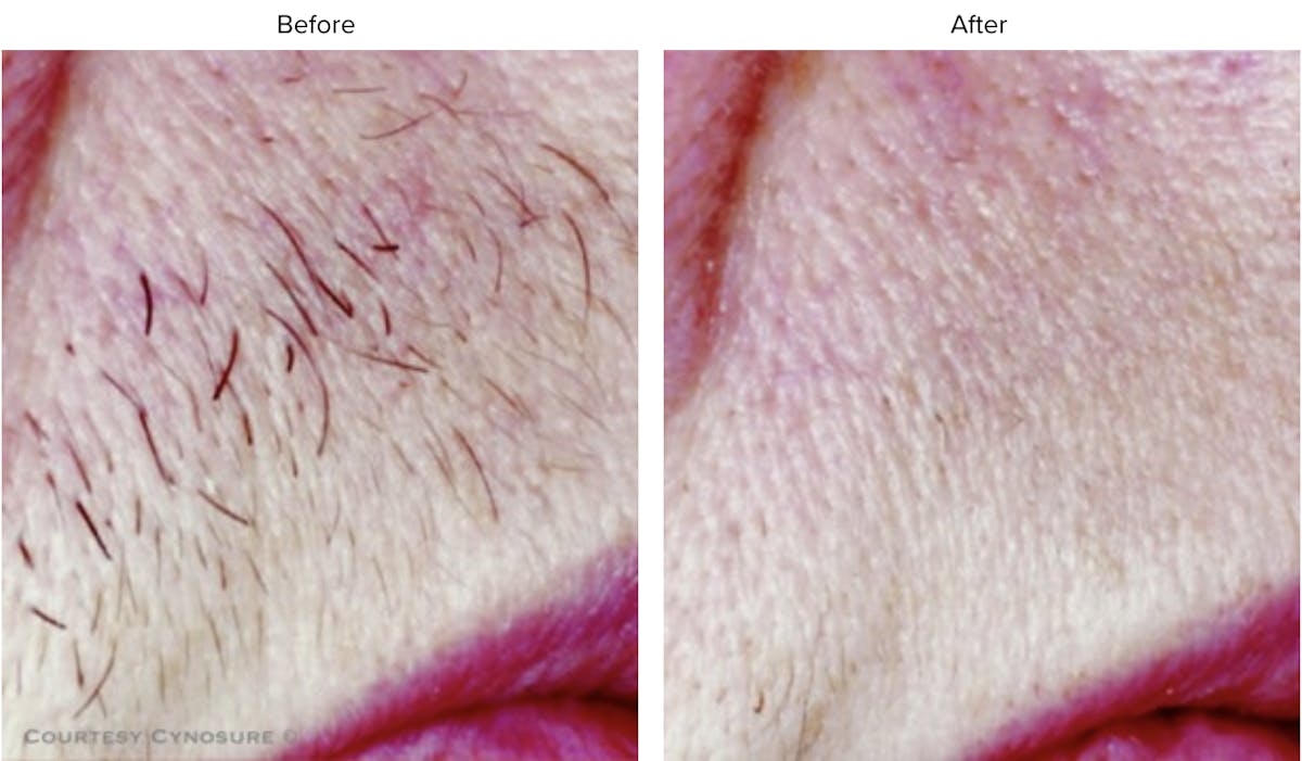 Laser Hair/Vein Removal Before & After Gallery - Patient 127410 - Image 1