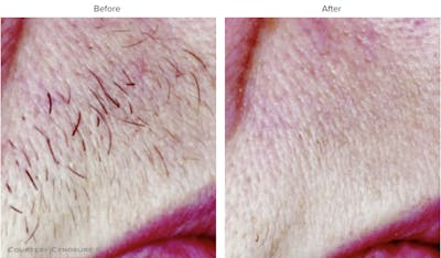 Laser Hair/Vein Removal Before & After Gallery - Patient 127410 - Image 1