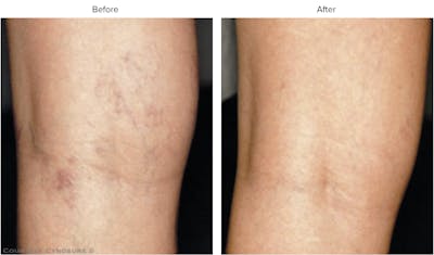 Laser Hair/Vein Removal Before & After Gallery - Patient 155727 - Image 1