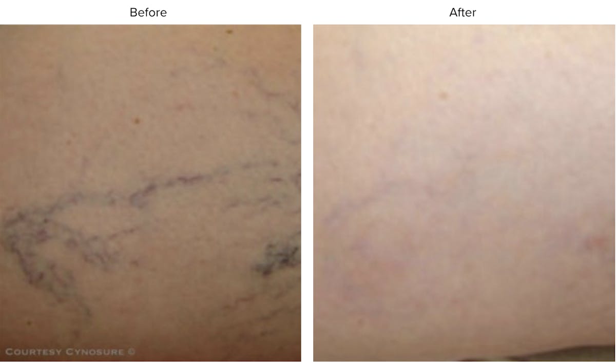Laser Hair/Vein Removal Before & After Gallery - Patient 167506 - Image 1