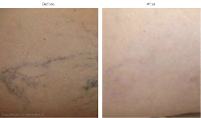 Laser Hair/Vein Removal Before & After Gallery - Patient 167506 - Image 1