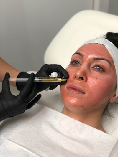 SkinPen Treatments Before & After Gallery - Patient 293406 - Image 1